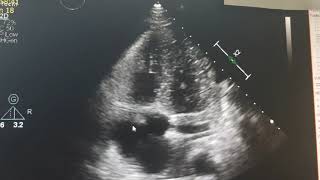 Infectious endocarditis Echocardiography [upl. by Niwrud630]