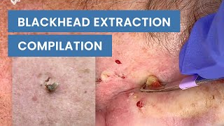 Extraction Satisfaction Blackhead Removal  CONTOUR DERMATOLOGY [upl. by Walling148]