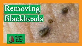 Several Blackheads  Auburn Medical Group [upl. by Haliehs]