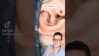 BLACKHEADS IN EAR  Blackhead Removal From Ear shorts [upl. by Eedeed]