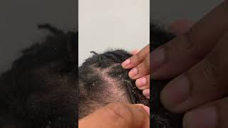 Itchy Scalp  Eczema Flare Up [upl. by Palma]