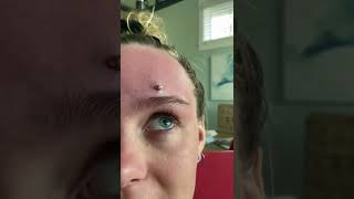 Cystic Acne Extractions Whiteheads  Blackheads Removal Today [upl. by Ispep]