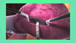 Atrial Septal Defect Repair at SSM Heart Institute [upl. by Sergeant719]