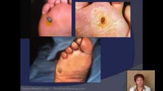 Corn amp Callus Debridement by a Podiatrist [upl. by Acinelav]