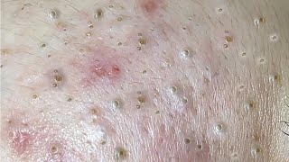 Nasa SPA 2021  Satisfying blackhead Acne Relaxing [upl. by Anerbas8]