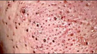 DR Skincare acne blackheadswhiteheads Treatments pimple Part 8 Full Screen HD [upl. by Ardnahsal]