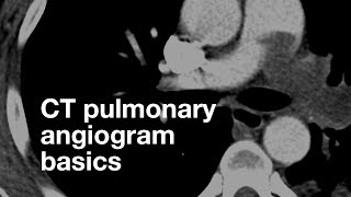 Pulmonary CT Angiogram Basics [upl. by Reuben]