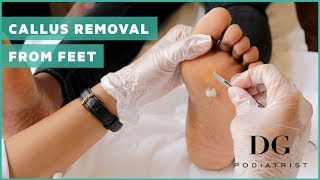 Callus removal from feet balls of feet [upl. by Baalbeer]