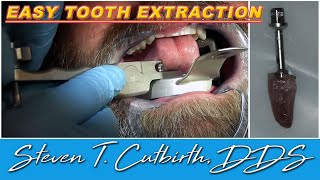 Easy Tooth Extraction  Dental Minute with Steven T Cutbirth DDS [upl. by Noguchi]