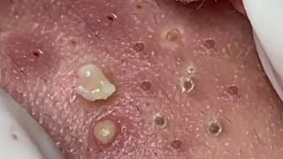 Nasa SPA 03 satisfying cyst relaxing blackhead pimple acne [upl. by Constantia]