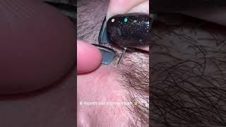 Squeeze blackheads spa  Big pimples on face treatment [upl. by Anaujait]