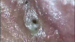 Popping Big Blackheads 😱 [upl. by Ylsew600]