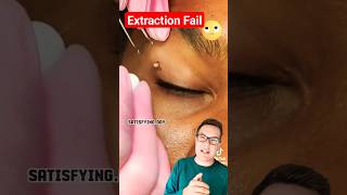 BLACKHEAD REMOVAL FAIL  Blackheads Around Eye shorts [upl. by Ulysses560]