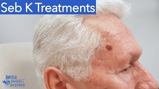 Seborrheic Keratosis Treatment amp Removal Liquid Nitrogen amp Curetagge [upl. by Yrol]