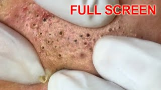 Blackheads removal  Best Pimple Popping Videos [upl. by Petey788]