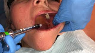 Inferior Alveolar and Lingual Nerve Blocks [upl. by Voltz631]