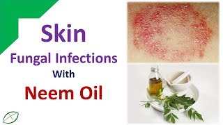 Get rid skin Fungal Infections with Neem Oil [upl. by Afesoj]