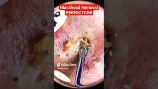 Rare BLACKHEAD REMOVAL  Perfect Blackheads Removal shorts [upl. by Ecienal635]