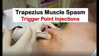 Trapezius Muscle Spasm Trigger Point Injection [upl. by Keelia]