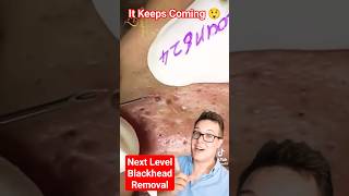 NEXT LEVEL BLACKHEAD REMOVAL  It Just Kept Coming shorts [upl. by Berl]