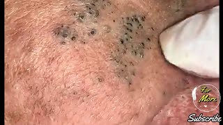 Dr Pop  Deep Blackheads in old Skin removing amp treatment 2020 Part 4 HD [upl. by Cartwell]