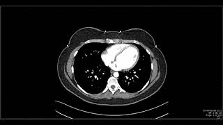 Abdominal Anatomy on Computed Tomography [upl. by Amehsyt]