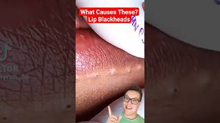 CRAZY BLACKHEAD REMOVAL AROUND LIPS shorts [upl. by Inobe]