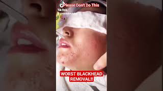 ❌ Worst BLACKHEAD REMOVAL Technique shorts [upl. by Jermain]