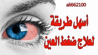 وصفة لعلاج ضغط العين المرتفع  High eye pressure natural herbal cure [upl. by Natsreik]