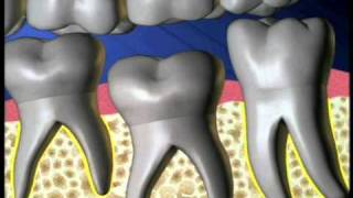 Ankylosis Tooth Oral Surgery [upl. by Lora]