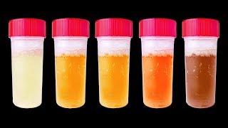 7 Choses Que Ton Urine Peut Révéler Sur ta Santé [upl. by Adliwa162]