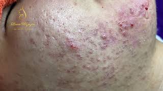 Blackheads Removal 333a  Loan Nguyen [upl. by Aidni]