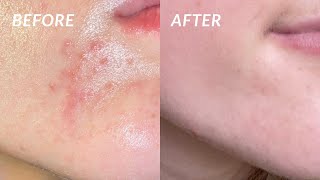 How I COMPLETELY got rid of my PERIORAL DERMATITIS in 4 DAYS the secret cure [upl. by Janie]